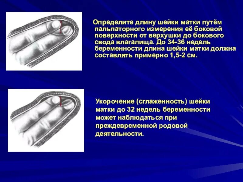 Можно ли достать до шейки матки. Пальпаторный метод измерения давления. измерение длины шейки матки. как определить длину шейки матки. как измеряют шейку матки.