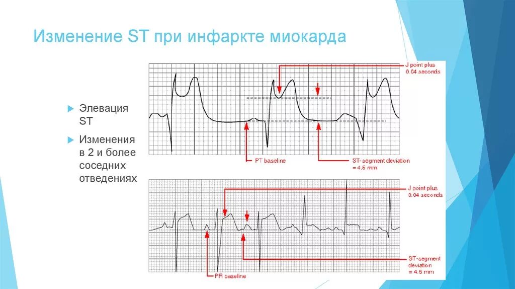 Зубец q после инфаркта миокарда. Элевация сегмента St при инфаркте миокарда. Изменения на ЭКГ при инфаркте миокарда. Изменения на ЭКГ при остром инфаркте миокарда.
