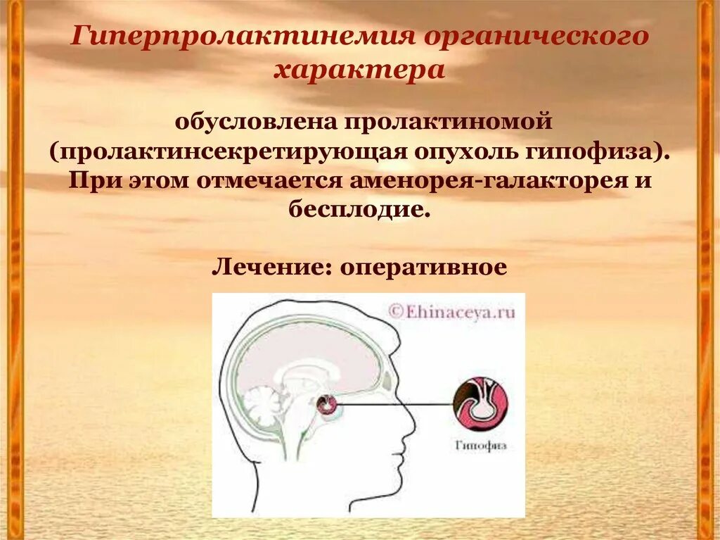 Опухоль гипофиза пролактинома. Пролактинома клинические проявления. Аденома гипофиза пролактинома. Пролактинсекретирующие аденомы. Пролактин микроаденома