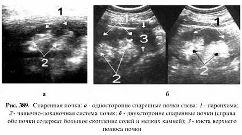 Диффузные изменения структуры синуса обеих почек