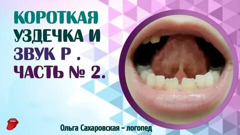 Упражнения для уздечки языка для ребенка