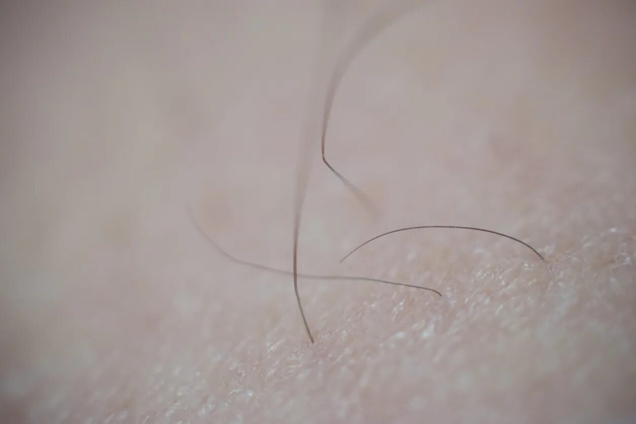 Стрижка лобковых волос. Псевдомикоз. Эпиляция бикини. У девочки растут лобковые волосы. Волосы под мышками женские.