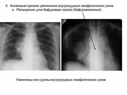 Лимфоузлы средостения увеличены
