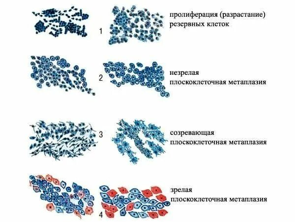 Плоскоэпителиальная метаплазия. Метаплазированный эпителий цитология. Плоскоклеточная метаплазия эпителия. Клетки плоскоклеточной метаплазии шейки матки. Клетки метаплазированного эпителия с реактивными изменениями