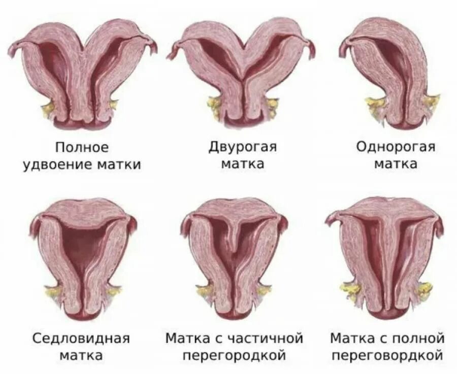 Врожденные пороки развития матки. Попороки развития матки. Аномалии строения матки.