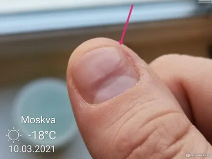 Сыворотка для ногтей стоп онихолизис