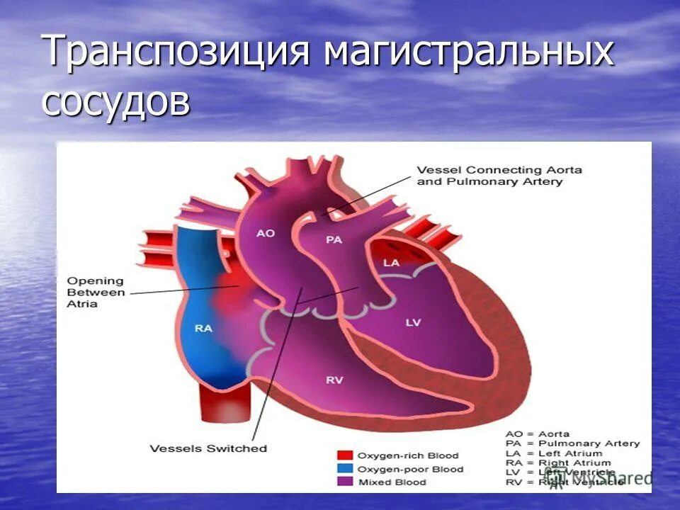 порок сердца транспозиция магистральных сосудов. транспозиция магистральных артерий у новорожденных. порок сердца транспозиция магистральных сосудов. этиология пороки магистральных сосудов. транспозиция магистральных сосудов причины.
