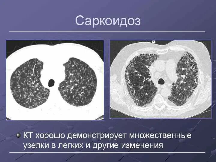 Лимфатические узлы на кт. Перифиссуральные узелки в легких что это. Внутрилегочные узлы на кт. Ревматоидное поражение легких. Ревматоидный артрит поражение легких.