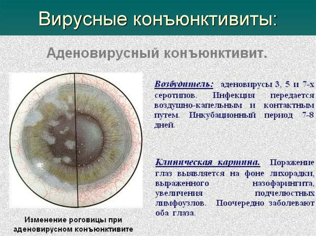 Конъюнктивит причины и лечение у взрослых. Аденовирусный кератит. фолликулярный герпетический конъюнктивит. фолликулярный кератоконъюнктивит. эпидемический фолликулярный конъюнктивит.