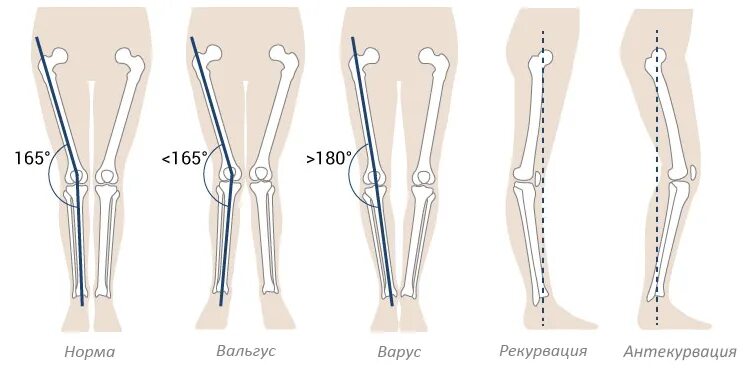 Деформация коленного сустава у детей. Варусная деформация коленного сустава оси. Вальгусная деформация искривление стопы. Dfhecyfz ltajhvfwbz JCB rjytxyjcnb. Варус вальгусная деформация.