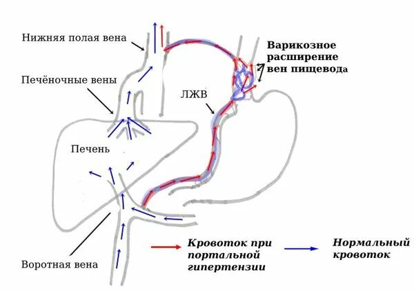 Варикозные вены пищевода мкб 10