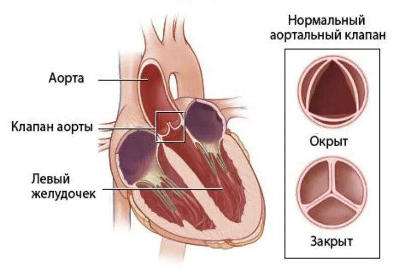 Уплотнение стенок аорты и створок аортального