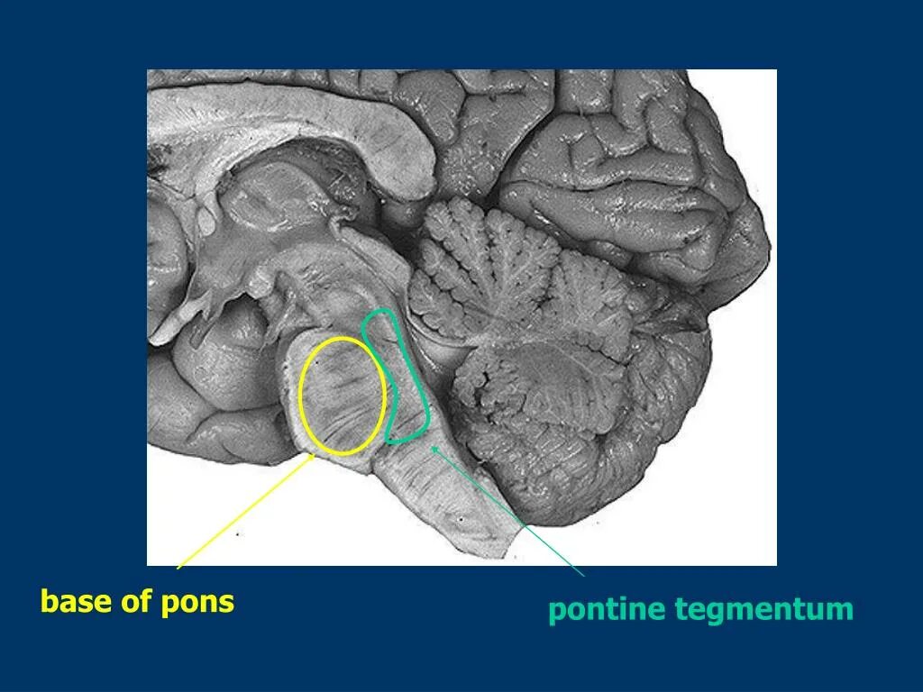 Варолиева моста головного мозга. Головной мозг варолиев мост. Продолговатый мозг и варолиев мост. Варолиев мост анатомия. Мозжечок анатомический препарат.