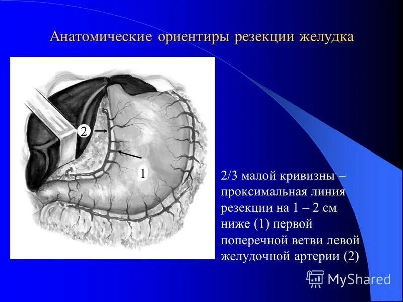 Линия резекции. Резекция тонкой кишки анастомозов техника. Гастрэктомия резекция желудка. Резекция тонкой кишки этапы. Паховая грыжа метод жирара.