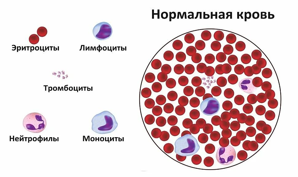Острый лейкоз