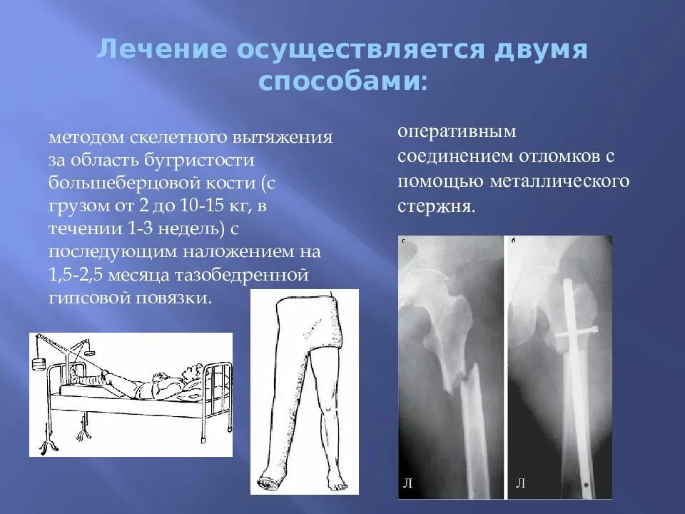 Лечение после переломов костей. Перелом бедра диафиза бедренной кости. Перелом диафиза бедренной кости лечение. Перелом диафиза бедренной кости клиника. Перелом диафиза бедренной кости гипс.