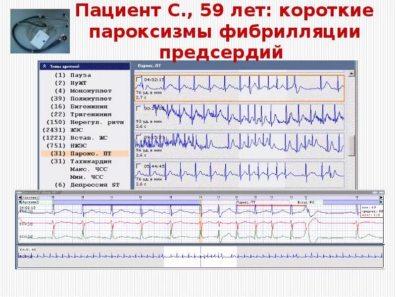 Тахисистолия это. Фибрилляция предсердий Холтер. Мерцательная аритмия холтеровское мониторирование. Фибрилляция предсердий при холтеровском мониторировании. Холтеровское мониторирование ЭКГ фибрилляция предсердий.