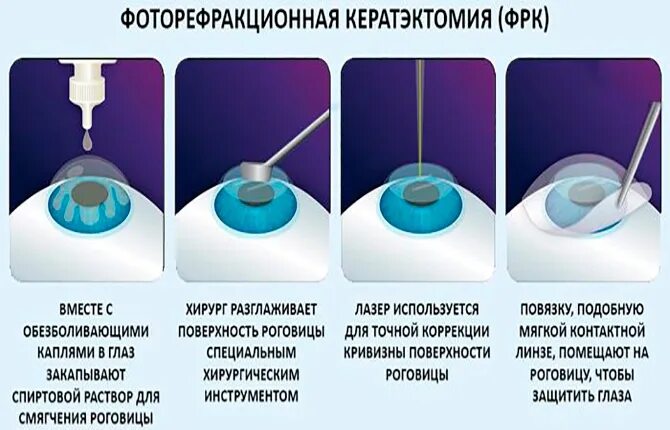 После лазерной коррекции зрения что нельзя делать. Фоторефрактивная кератэктомия ФРК. Коррекция зрения по технологии ФРК (фоторефракционная кератэктомия). Эксимер-лазерная фоторефракционная кератэктомия.