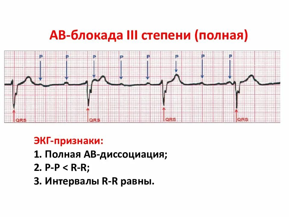 Атриовентрикулярная блокада признаки. Полная атриовентрикулярная блокада 3 степени на ЭКГ. АВ-блокада III степени на ЭКГ. ЭКГ АВ блокада 3 степени ЭКГ. Полная АВ блокада 3 степени ЭКГ.