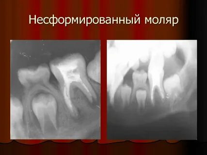 Временные моляры