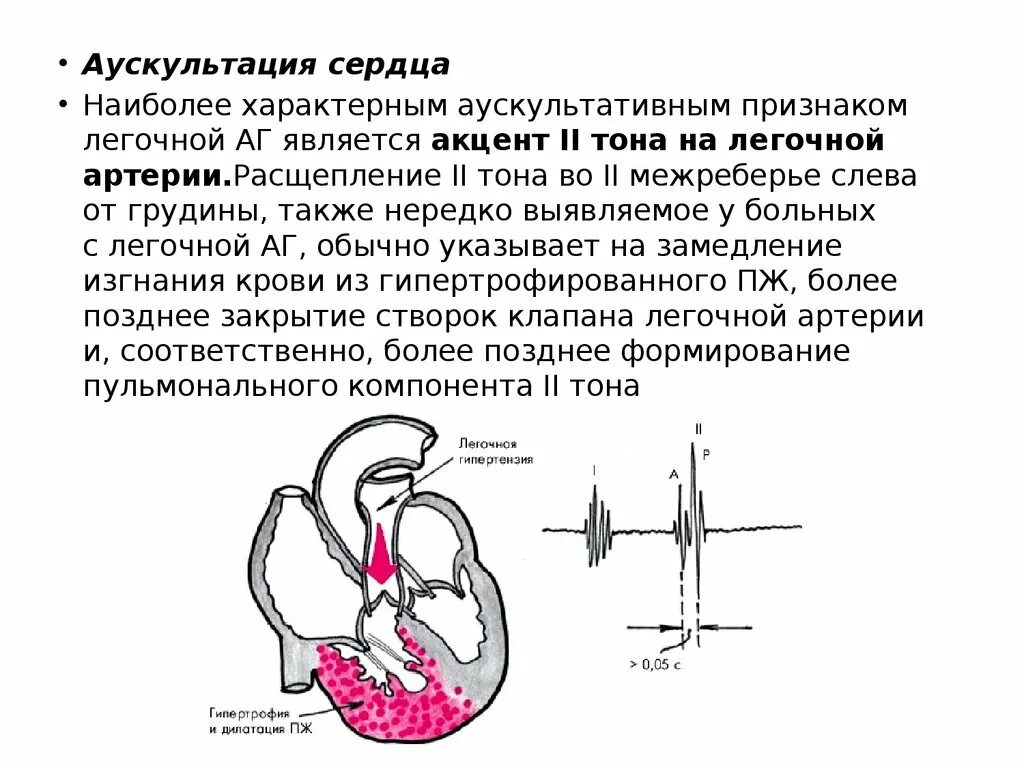 Акцент 2 тона над легочной артерией механизм. Аускультация легочной артерии. Стеноз легочной артерии шум. Акцент ii тона на легочной артерии. Стеноз легочной артерии аускультация.