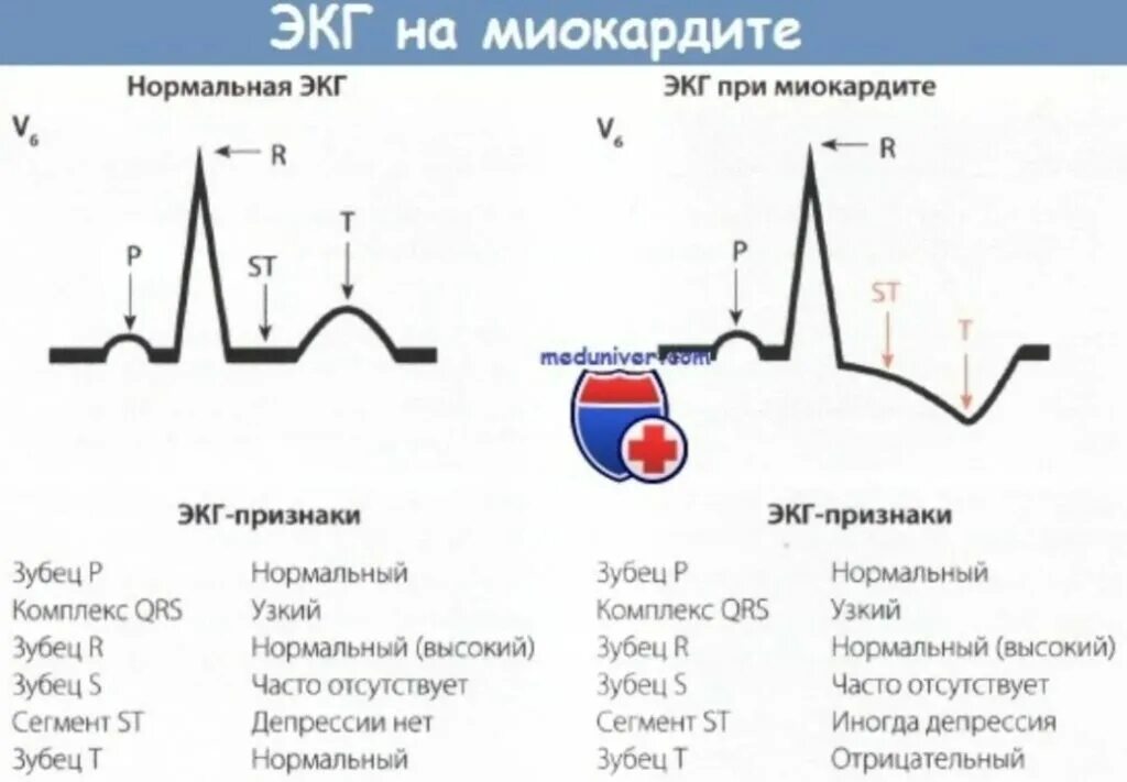 Диффузные повреждения на экг что значит. Изменения на экг при миокардите. миокардит симптомы на экг. миокардит на экг у детей. острый миокардит экг.