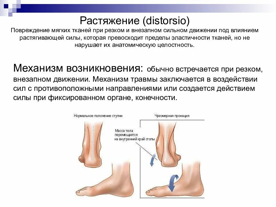 Классификация травма голеностопного сустава растяжение связок. Растяжение связок голеностопного сустава синяк. Растяжение связок стопы стопы.