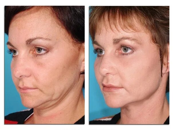 Подтяжка лица до и после женщины facelift surgery before and after #Facelift #Surgery Types of plastic surgery,