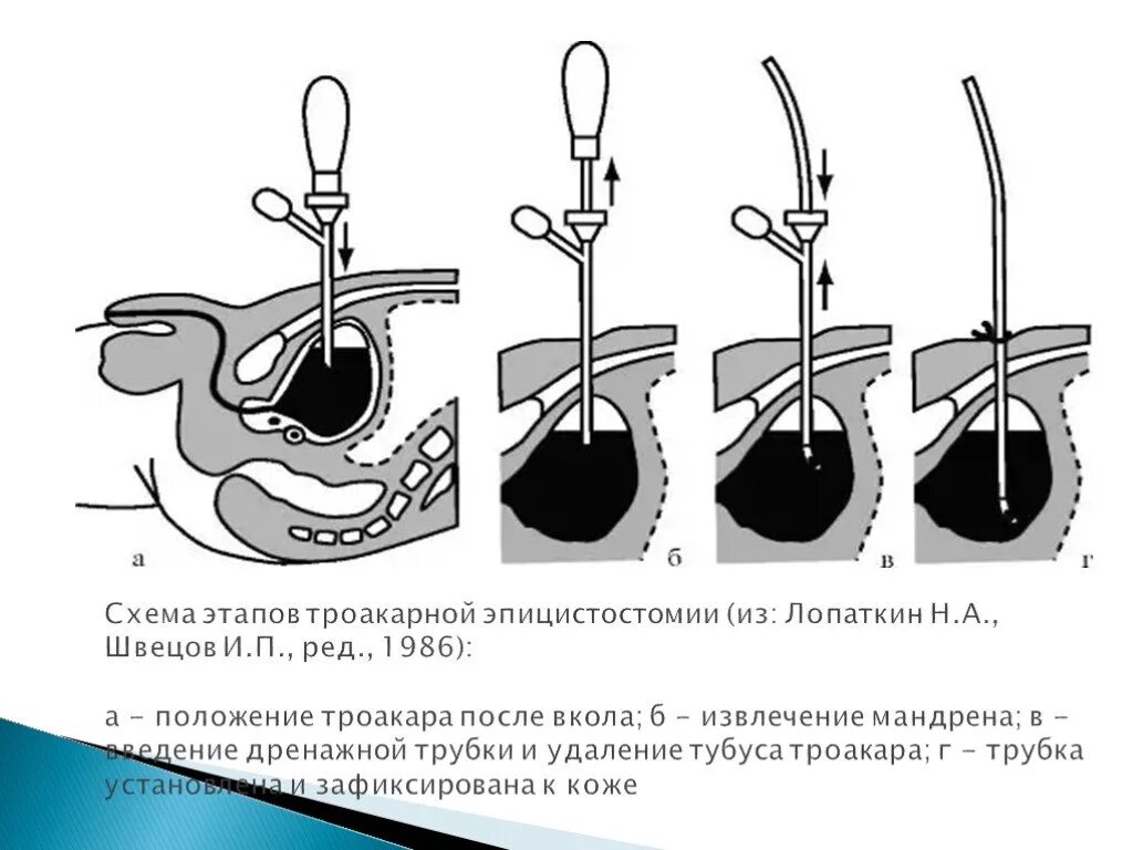 Трубочку в мочевой пузырь. Троакарная пункция мочевого пузыря. Троакарная эпицистостомия техника. Надлобковая пункция мочевого пузыря троакаром. Троакарная цистостомия техника.