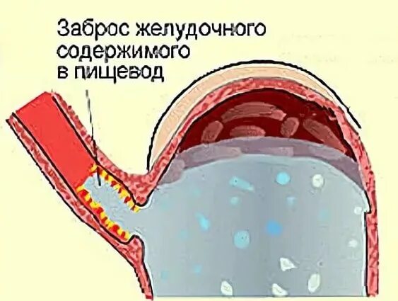 Заброс содержимого желудка в пищевод. Упражнения при рефлюксной болезни. Дыхательная гимнастика при ГЭРБ. Упражнения при рефлюксной болезни гастроэзофагеальной.