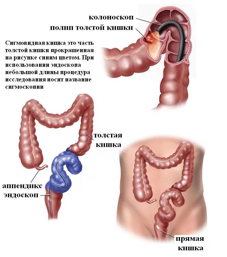 Колоноскопия это метод исследования. Колоноскопия кишечника сигмовидная кишка. Колоноскопия эндоскоп. Колоноскопия подготовка пациента алгоритм. Колоноскопия толстого кишечника подготовка.