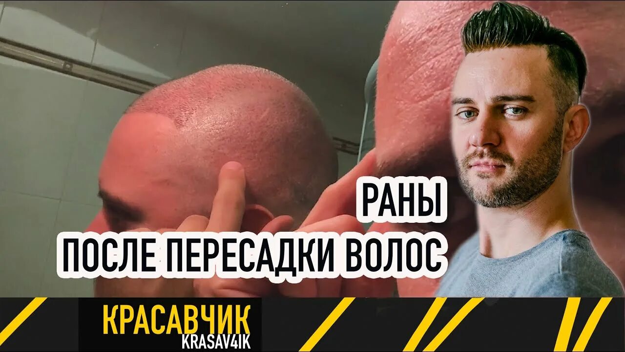 Как выглядит донорская зона после пересадки Донорская зона волос