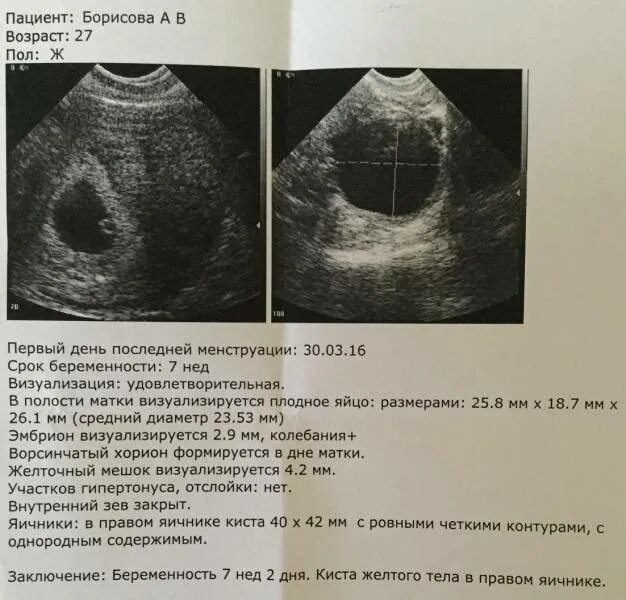 Желточный мешок при беременности 5,5 мм. УЗИ 5-6 недель плодное яйцо в матке. Плодное яйцо 7 недель на УЗИ В матке. Желточный мешок 5 мм не визуализируется. Почему не видно эмбрион