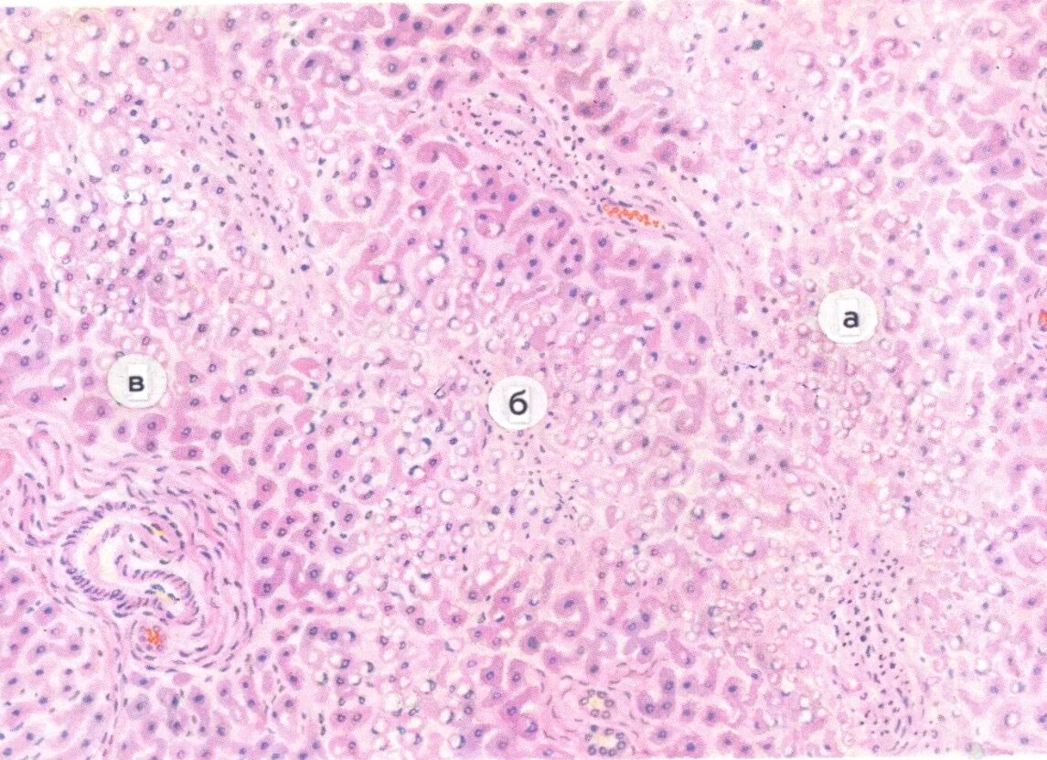 Токсическая дистрофия печени. Препарат гематоксилин эозин. Токсическая дистрофия печени микропрепарат. Токсическая дистрофия печени патанатомия.