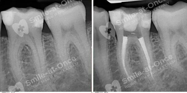 Запломбированный канал в зубе снимок. Рентген снимок запломбированного канала зуба. Пульпит 3х канального зуба.