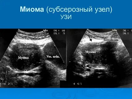Синехии в матке на узи