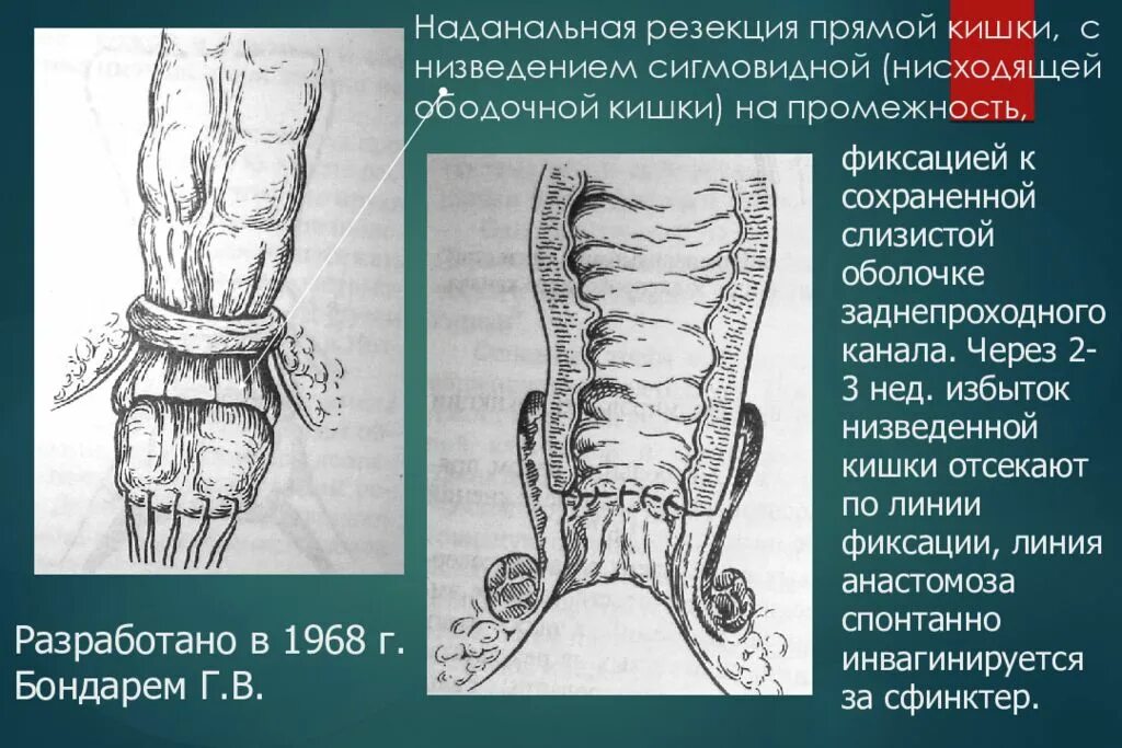 Повредил прямую кишку