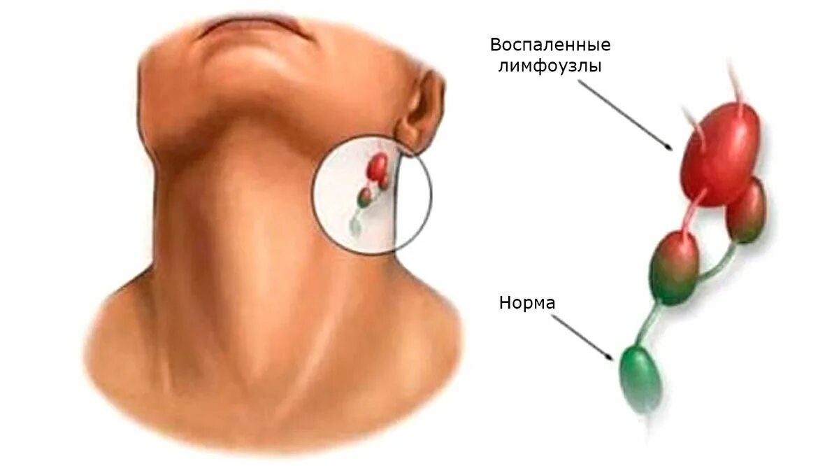 Гнойный шейный лимфаденит. Воспалённый подчелюстной лимфоузел. Регионарный лимфаденит сифилис. Лимфаденит надключичных лимфоузлов. Прощупывается лимфоузел на шее