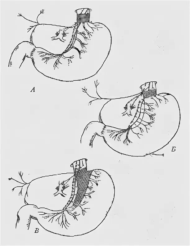 Хирургические заболевания желудка. Стволовая ваготомия с дренирующими желудок операциями. Осложнения ваготомии желудка. Дренирующие операции на желудке. Схема ваготомии стволовой.