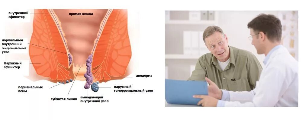 Спазм прямой кишки