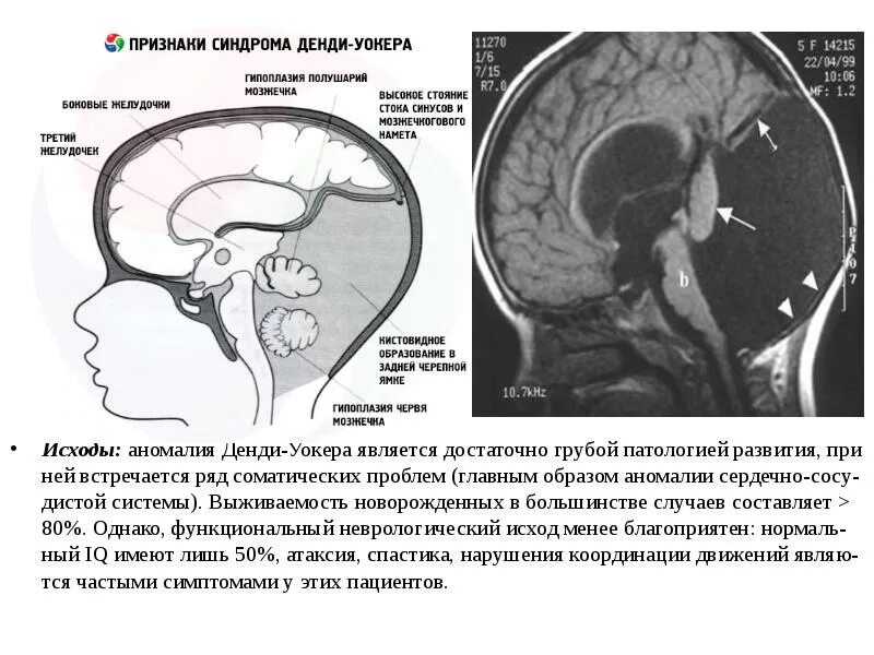 Внутриутробное недоразвитие головного мозга. Гипоплазия мозжечка, аномалия Денди-Уокера. Гипоплазия червя мозжечка кт. Синдром Денди Уокера на УЗИ. Денди Уокера синдром мрт.