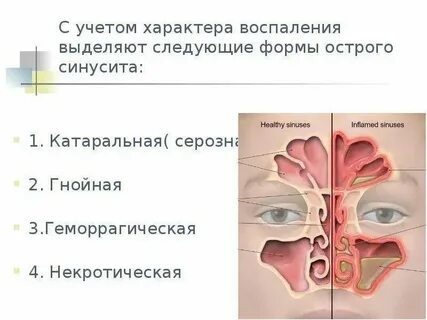 Острый левосторонний катаральный
