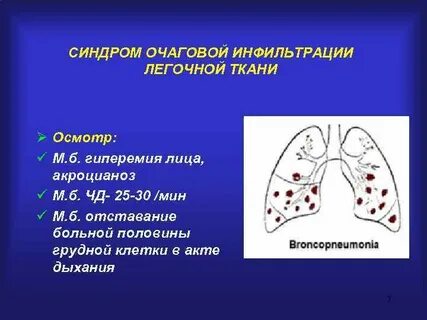 Участки инфильтрации легочной ткани