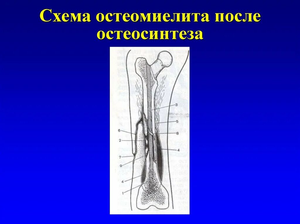 Остеомиелит остеосинтез. Остеомиелит после остеосинтеза. Остеосинтез при остеомиелите. Послеоперационный остеомиелит. Осложнения остеосинтеза