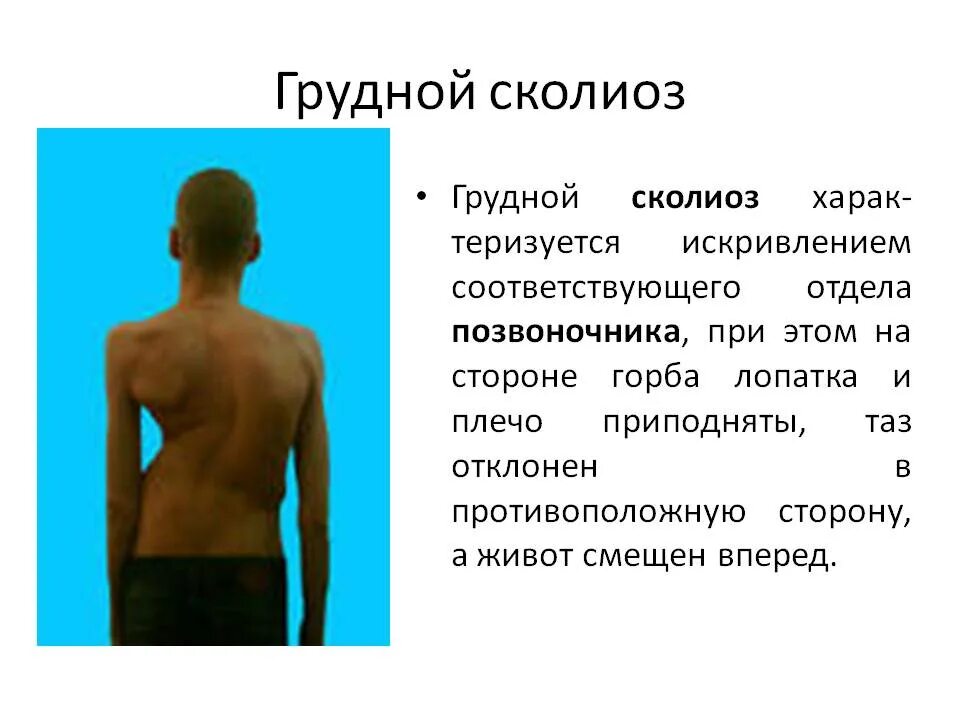 Можно вылечить сколиоз 2 степени. Сколиоз грудного отдела позвоночника 3 степени. деформация грудной клетки при сколиозе 1 степени. левосторонний сколиоз верхнегрудного отдела 1 степени. s образный сколиоз грудного отдела 3 степени.
