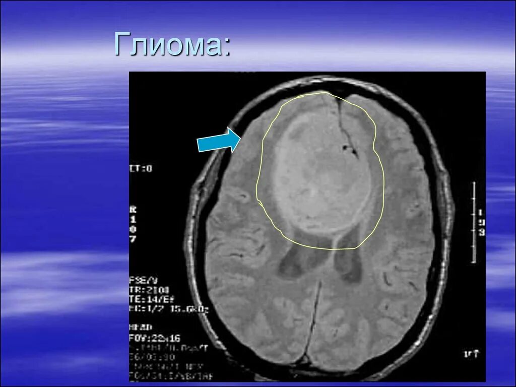 Что такое глиома. Диффузная глиома ствола. Глиома зрительного нерва мрт.