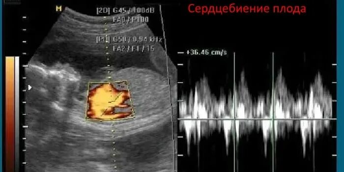 Частота сердечных сокращений у плода 7 недель. Узи контроль сердцебиения плода. Частота сердечных сокращений у плода. Сердцебиение плода на раннем сроке. Сердцебиение плода в 12 недель норма.