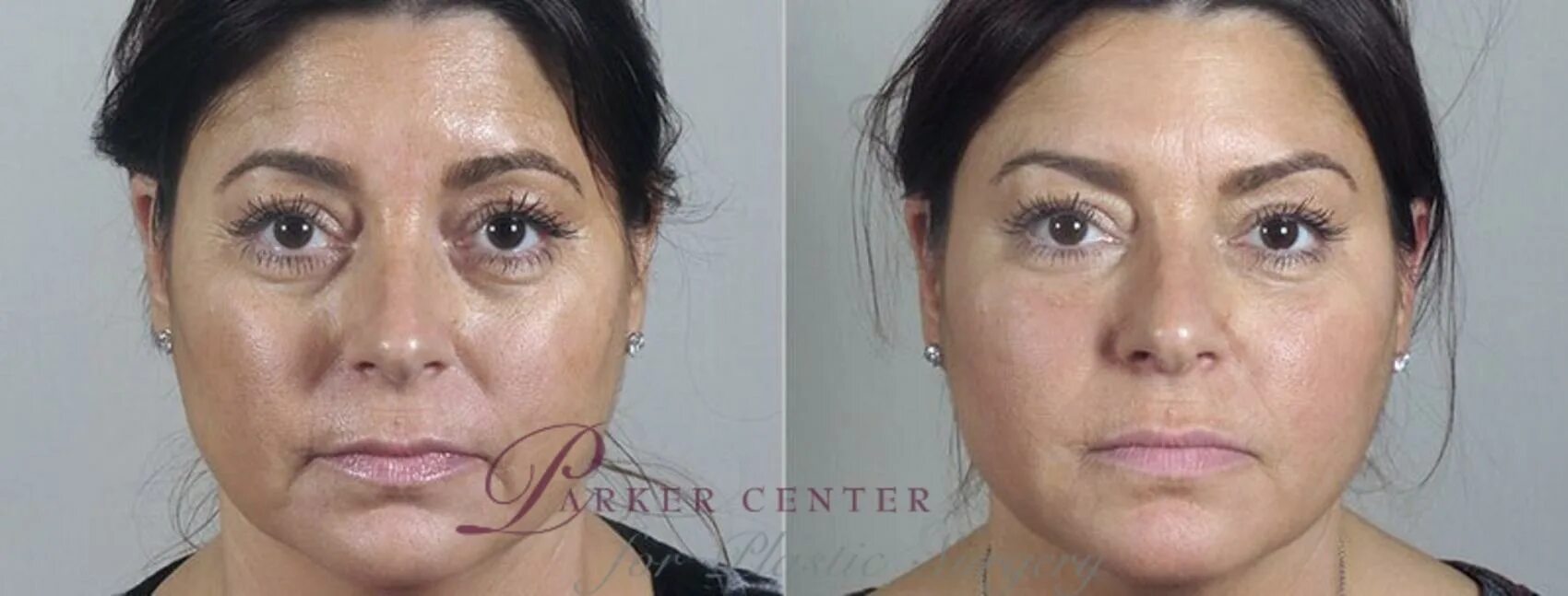 Бодифлекс для лица до и после. Морщины между бровями. Горизонтальная морщина между бровями. Межбровная морщина. Поперечная морщина на переносице.