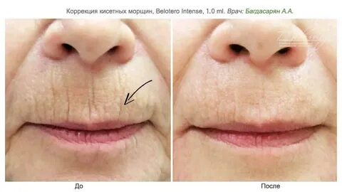Убрать кисетные морщины отзывы