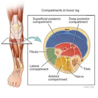 Leg syndrome